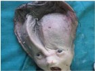 hydrocephalus